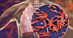 State Declares Public Health Emergency After Tuberculosis Outbreak: 1 Dead, 14 Infections Confirmed – 170 Likely Exposed